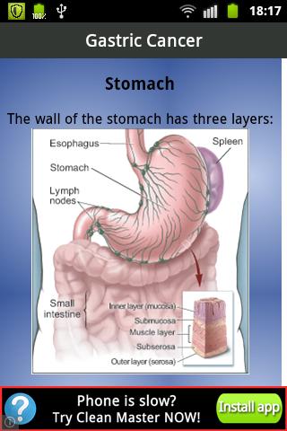 Gastric Cancer